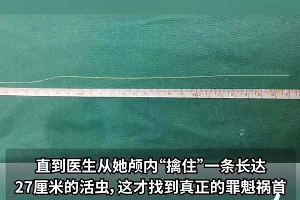 你還敢喝生水嗎？女子頭疼開(kāi)刀竟取出27厘米活蟲(chóng)！